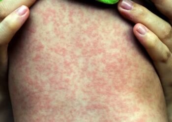 EUA bajo alerta: Sarampión se dispara y Chikungunya llega a NYC