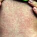 EUA bajo alerta: Sarampión se dispara y Chikungunya llega a NYC