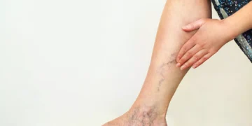 Día Mundial Trombosis: Urgente Llamado a Prevenir y Salvar tu Vida