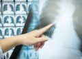 Adiós Cáncer de Pulmón: La Detección Temprana Es Tu Cura