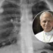 Que es el adenocarcinoma el cancer de pulmon diagnosticado al papa Leon XIV